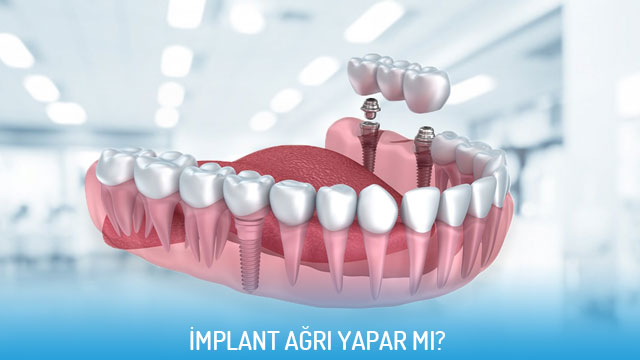 implant.jpg