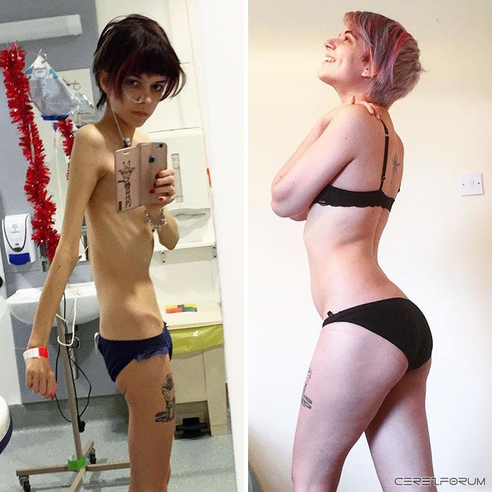 anorexia-recovery-before-after-118-58f61902e2172__700.jpg