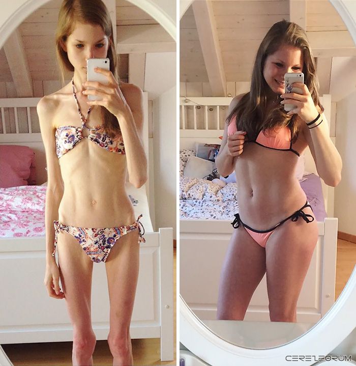 anorexia-recovery-before-after-195-59100917d9eb6__700.jpg