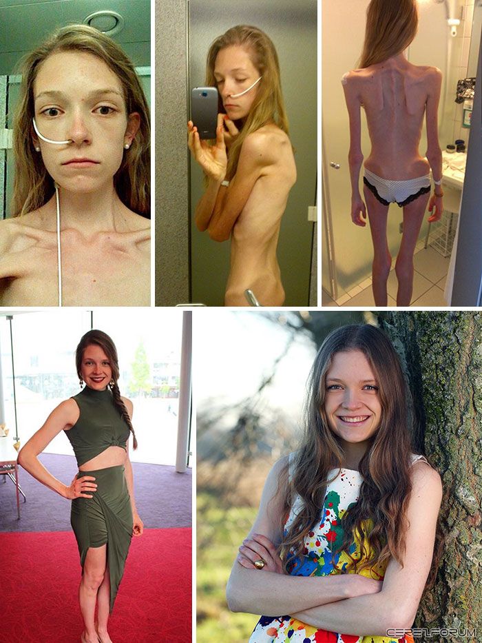 anorexia-recovery-before-after-130-58f7209c5d1f7__700.jpg