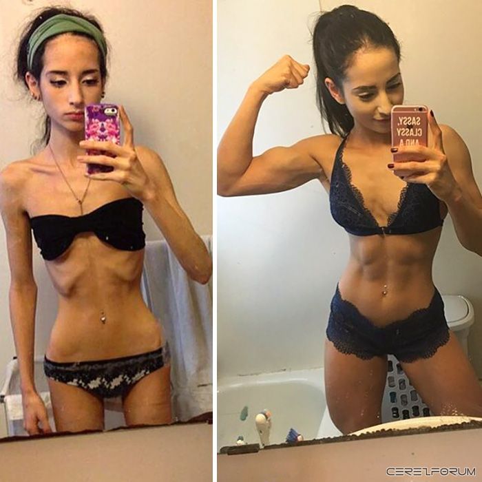 anorexia-recovery-before-after-164-590084c14d47b__700.jpg