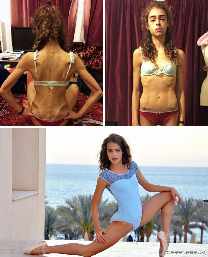 anorexia-recovery-before-after-124-58f6741230664__700.jpg